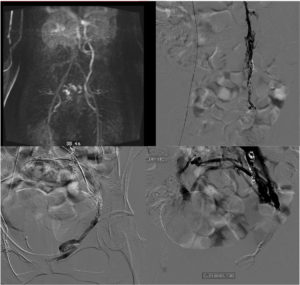 varices pelviennes symptomatiques)