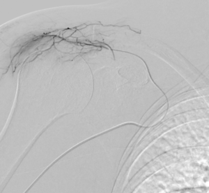 Artériographie épaule