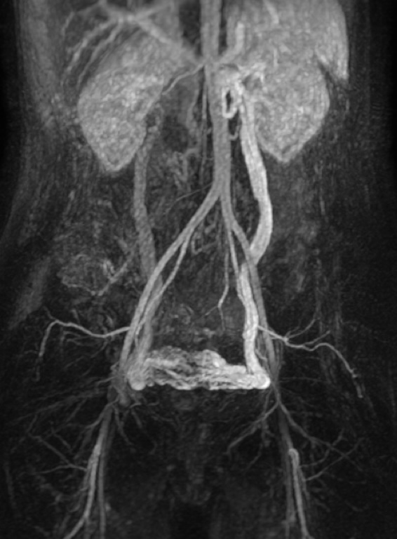 Varices pelviennes - IRM