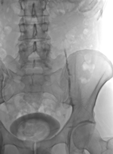 Embolisation varicocèle après traitement
