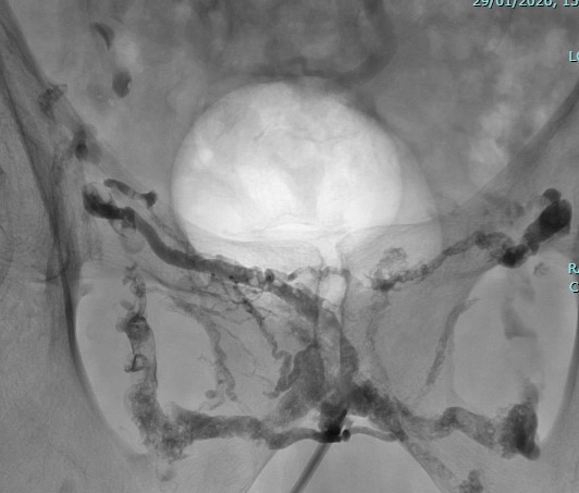 Angiographie de contrôle après injection de Glubran et Lipiodol
