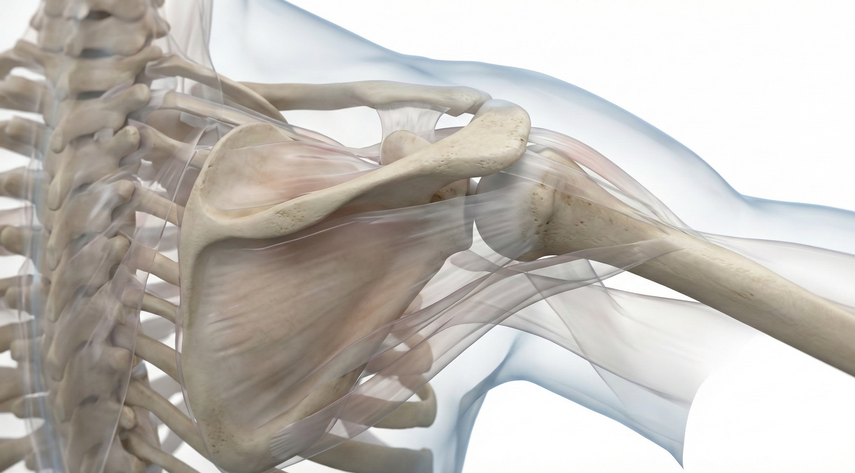 Embolisation capsulite - Épaule