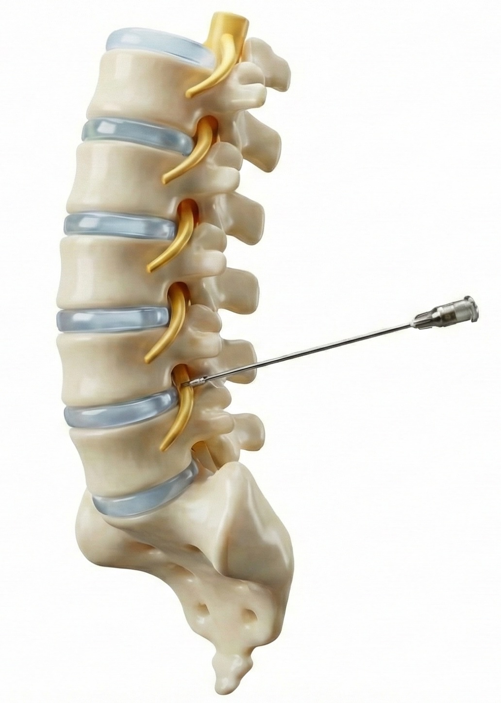 Radiofréquence lombaire - Colonne lombaire