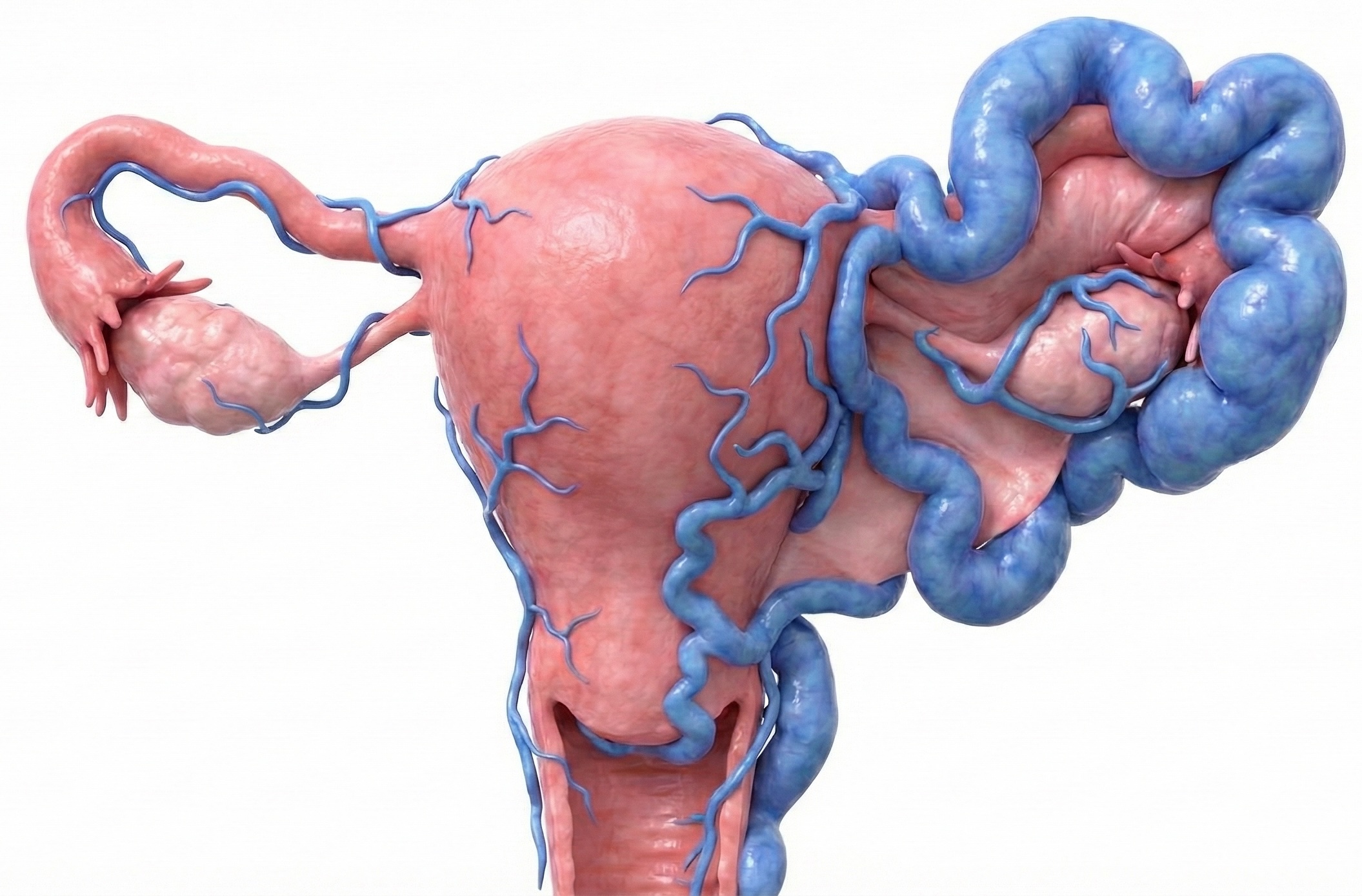 Embolisation varices pelviennes - Utérus