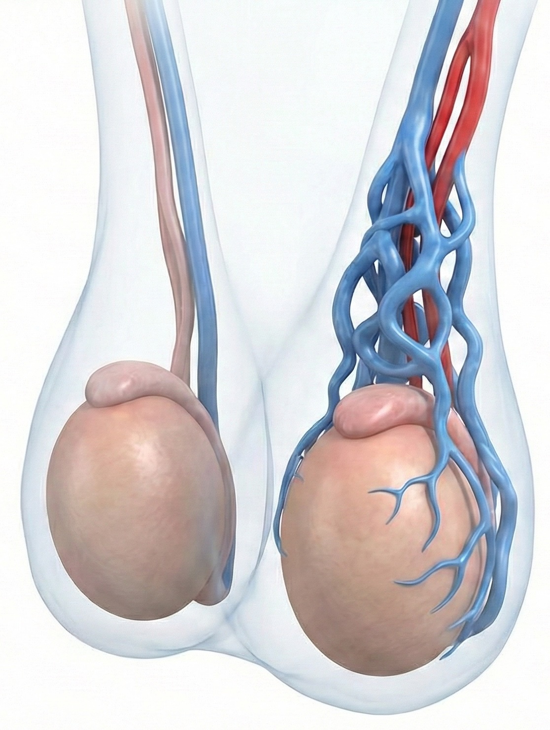 Embolisation varicocèle - Testicules