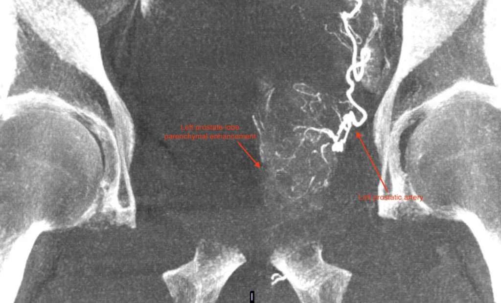 opacification 3D CBCT