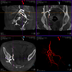 CBCT acquisition pelvienne au temps artériel