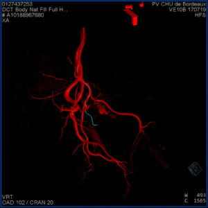 Reconstruction 3D de l'artère prostatique