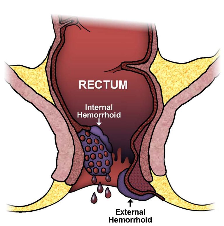 Emborrhoid Embolisation d'hémorroides Radiologie Interventionnelle