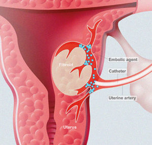 Embolisation utérine