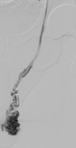 opacification varicocele