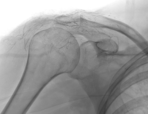 Lipiojoint